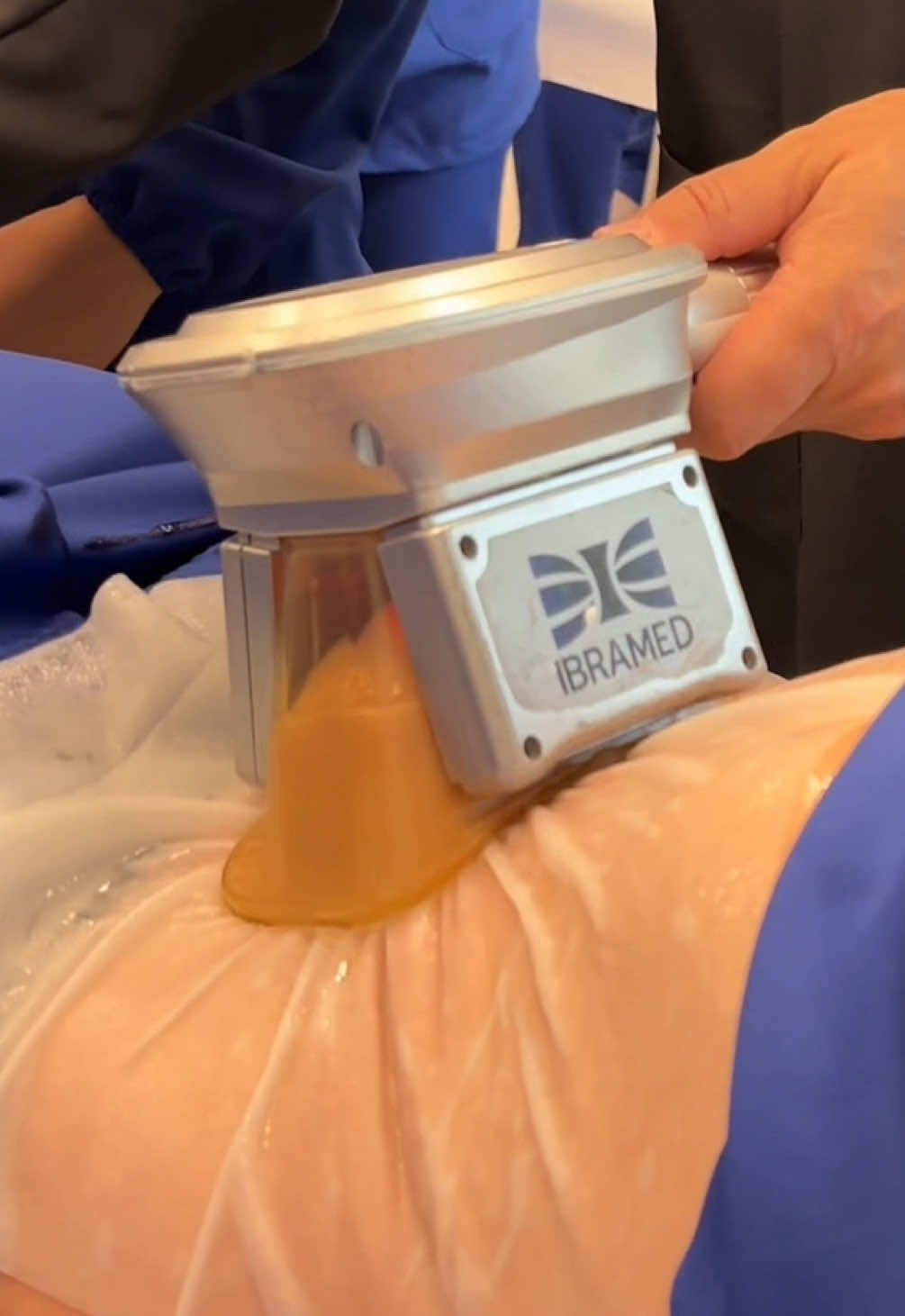 Você conhece a Criolipólise? Sabe como funciona? Fica no vídeo que te mostro o passo-a-passo ☺️ É uma técnica que ajuda a reduzir gordura localizada com ajuda de uma manta para proteger a pele do frio. #estetica #farmacia #criolipólise #mantaprotetora #gorduralocalizada #aula #pósgraduação