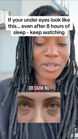 Concealer creasing, dark circles, hollow eyes? It might be deeper than skincare #over30 #over40 #undereyebags #tiredskin #agingwell #glowfromwithin 