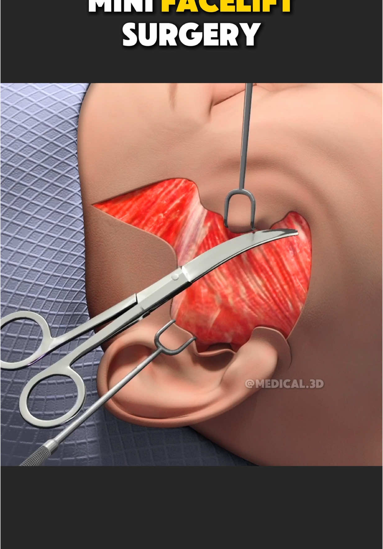 Mini Facelift Surgery (3D Animation) #minifacelift #facelift #faceliftsurgery #faceliftjourney #facesurgery #cosmeticsurgery #saggyface #medical3danimation #3dmedicalanimation 