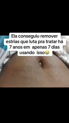#estrias #manchas #pelerrica 