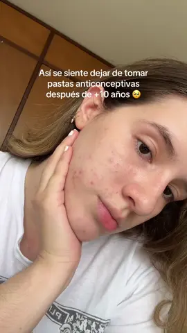 Dejé las patas anticonceptivas después de +10 años de tomarlas y esto me pasó 😓 #acne #acnefighter #anticonceptivos 