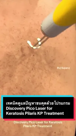 เทคนิคดูแลปัญหาขนคุดด้วยโปรแกรม Discovery Pico Laser for Keratosis Pilaris KP Treatment  #ขนคุดสีแดง #KPrubra #keratosispilarisrubra #ดูแลขนคุด #เลเซอร์ขนคุด #รูขุมขนอักเสบ #Keratosispilaris #KP #ครีมบำรุงผิว โปรแกรม #picosecondlaser #รักษาขนคุดที่แขน #ขนคุดอักเสบ #วิธีรักษาขนคุด #ขนคุดที่แขน #ขนคุดที่หน้า #ขนคุดที่หลัง โปรแกรม #discoverypicolaser #RujSuparuj #demedclinic #รุจชวนคุย  @Ruj Suparuj 