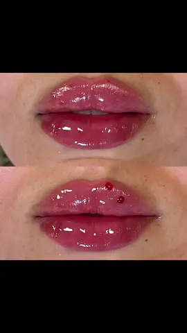 #modesto #acidohialuronico #parati #foryoupage #skincare #lips #nariz 