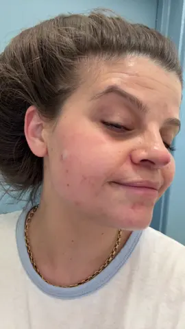 On today’s episode of what it’s like to be a diabetic…. #type1diabetes #diabetesawareness #skinproblems #realskintexture #realskintalk #type1warrior #dexcomwarrior 