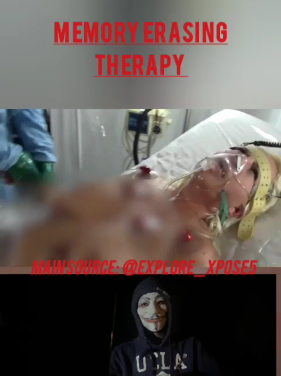 Electroconvelsive Therapy Memory erasing therapy Medical practice #medical #viralvedio #electroconvulsivetherapy #ot #viralvedio #therapy #mental #foryoupage 