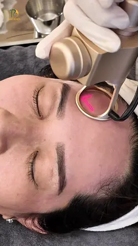 ✨ Giải pháp Fractional CO2 tại Bảo Duyên Công nghệ vi điểm giúp tái cấu trúc da, làm mịn lỗ chân lông và giảm sắc tố. Liệu trình được cá nhân hóa tại phòng khám da liễu Bảo Duyên #PhongKhamDaLieuBaoDuyen #TranMinhDuyen #BaoDuyenClinic #fractionalco2laser 