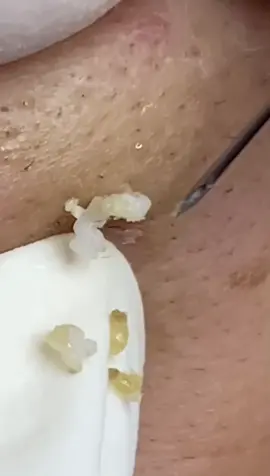 Bom diaaa! Cravos que pareciam pequenos e saíram gigantesss😍😍 #CleanTok #viralvideos #blackheads #limpeza #foryoupage #satisfaction 
