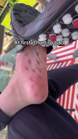 Link in bio! #acupuncture #painrelief #pain #slipper #massage 