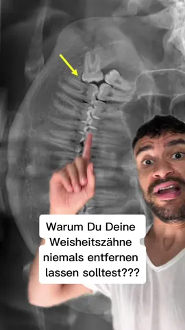 Weisheitszähne niemals entfernen lassen??? #weisheitszähne #zahngesundheit #zahnarzt #gesundheitstipps #aufklärung 