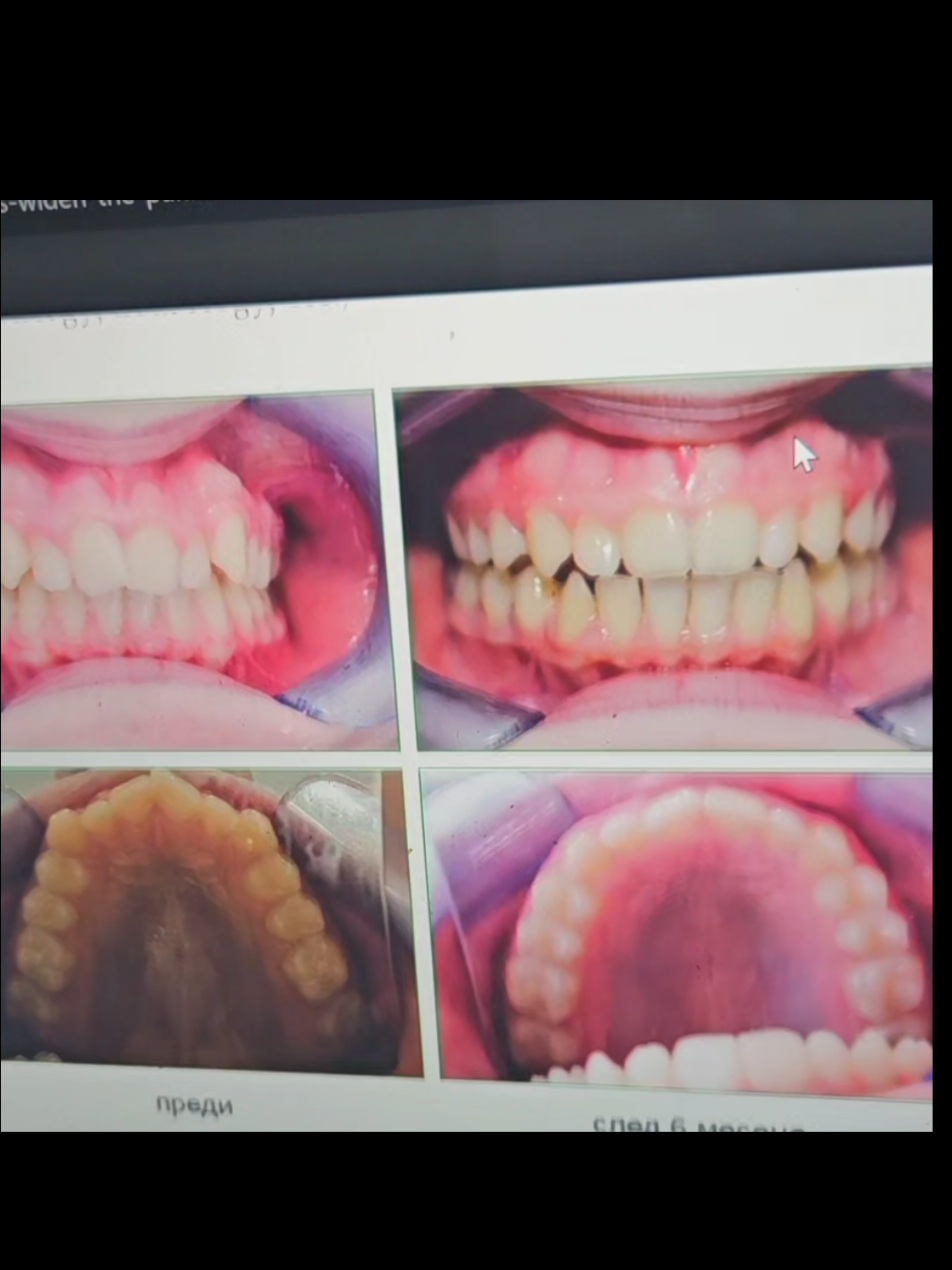 and it lasts a whole year + free replacement if it doesn't.  medium size for women, large size for men.  #reviv #palateexpansion #braces #invisalign 