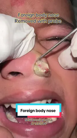 #foreignbodynose #foryou #viral #fyp #fypシ゚viral #ent #entdoctorbutwal #doctor 