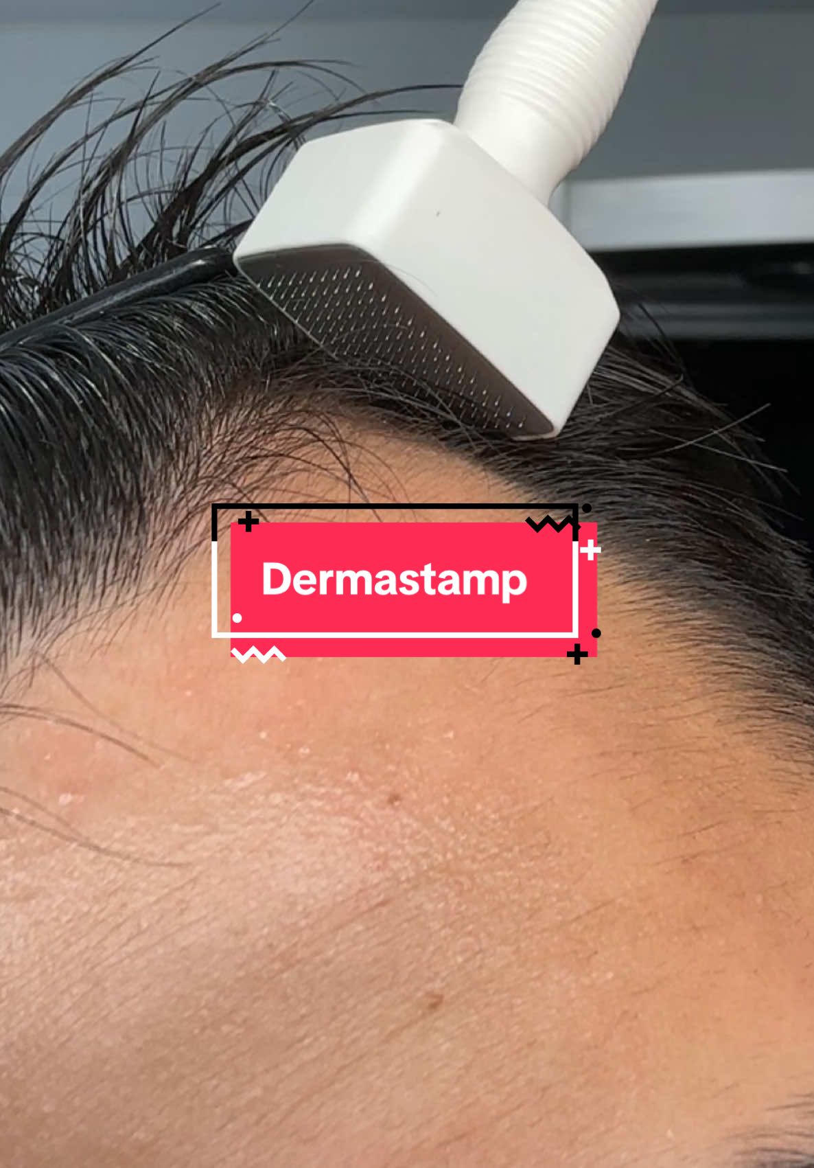 Day 82 of Minoxidil. Today we are using the Derma Stamp which works like the dermaroller. . #fyp #minoxidil #hairloss #dermastamp #hairroutine #pourtoi