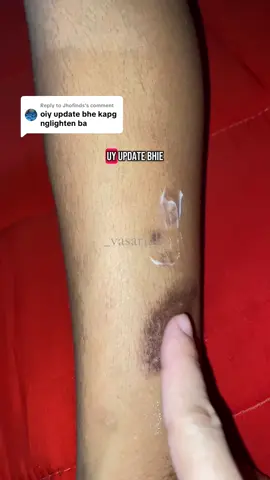 Replying to @Jhofinds #scar #maycheer #scars #scarcream #skincare 