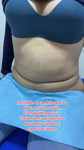 #endolifting #paratiiiiiiiiiiiiiiiiiiiiiiiiiiiiiii #rejuvenecimiento #belleza #piel #laser #lima #arequipa #cuzco #miasolutions 