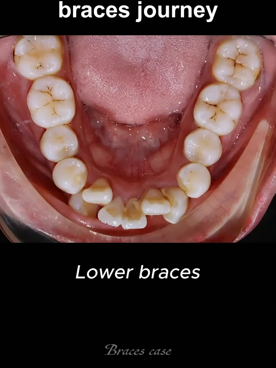 Crooked teeth braces transformation. 25 month duration #braces #dentist #bracesoff #orthodontist 
