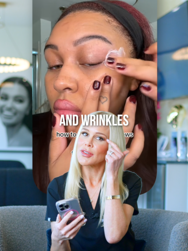 Trouble getting rid of these wrinkles? Botox is the treatment for you 💉 Credits: @_jadync #renewoklahoma #aesthetics #crowsfeet #wrinkles #guasha #botox #injections #reaction
