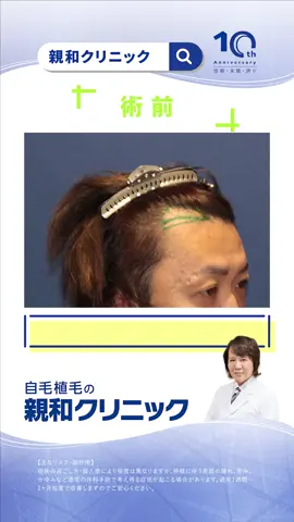 #AGA治療 #自毛植毛 #薄毛治療 #親和クリニック