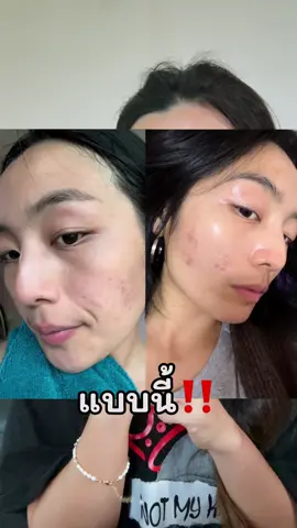 หน้าใส ไร้รอยสิวต้องนี่เลย Yuja Symwhite 377 #ป้ายยาสกินแคร์ #สกินแคร์ #g2g #glad2glow 