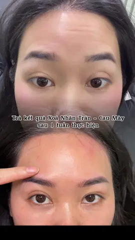 Hết nhăn luôn ạ