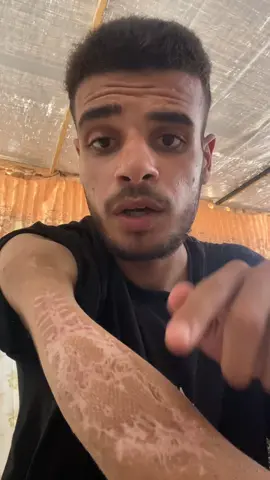 Save Mahmoud and his hand ‏#fyp #fup #viral #foryoupage #govirall #fypsy #fypg #fyyyp #frp #kids #business #fyyy #f #fyp #foryou ##foryoupage #fypppppppppppppppppppppppppppppppppp #viral #water #Home #food #job #usa #indonesia #dubai🇦🇪 #unfrezzmyaccount #support_me #dubaichocolate #foryou #fypシ #foryoupage #viralvideo #trend #explore #Love #support #helpme #life #family #saveus #tiktok_arab #palestine #rebuild #hope #future #dubai #usa #indonesia #tiktok #tiktokviral #fypdaily #momlife #baby #reallife #savelives #war #refugees #recovery #motherhood #voice #gaza #prayforus #helpnow #emergency #humanity #peace #rebuildhope