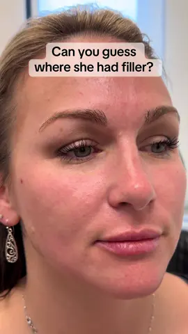 it’s THAT natural 😉  #filler #fyp 