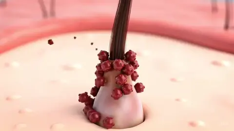 Why are you going bald? It’s not just genetics… it’s DHT. Dihydrotestosterone (DHT) is a powerful hormone that shrinks your hair follicles over time — leading to thinner strands, slower growth, and eventually permanent hair loss. For most men, excess DHT is the real reason behind receding hairlines and thinning crowns. The good news? You can fight back. Take control before it’s too late. 👊 #hair #DHT #hairlosssolutions #haircareroutine #HairCareTips #hairgrowth #hairfail #hairthinning #hairline #hairproblems 