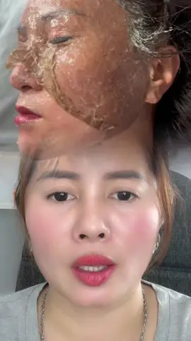 Thánh thần thiên thụn thùn thung ơi#xuhuong #tinh_chất_hút_sắc_tố_nám_tàn_nhang 