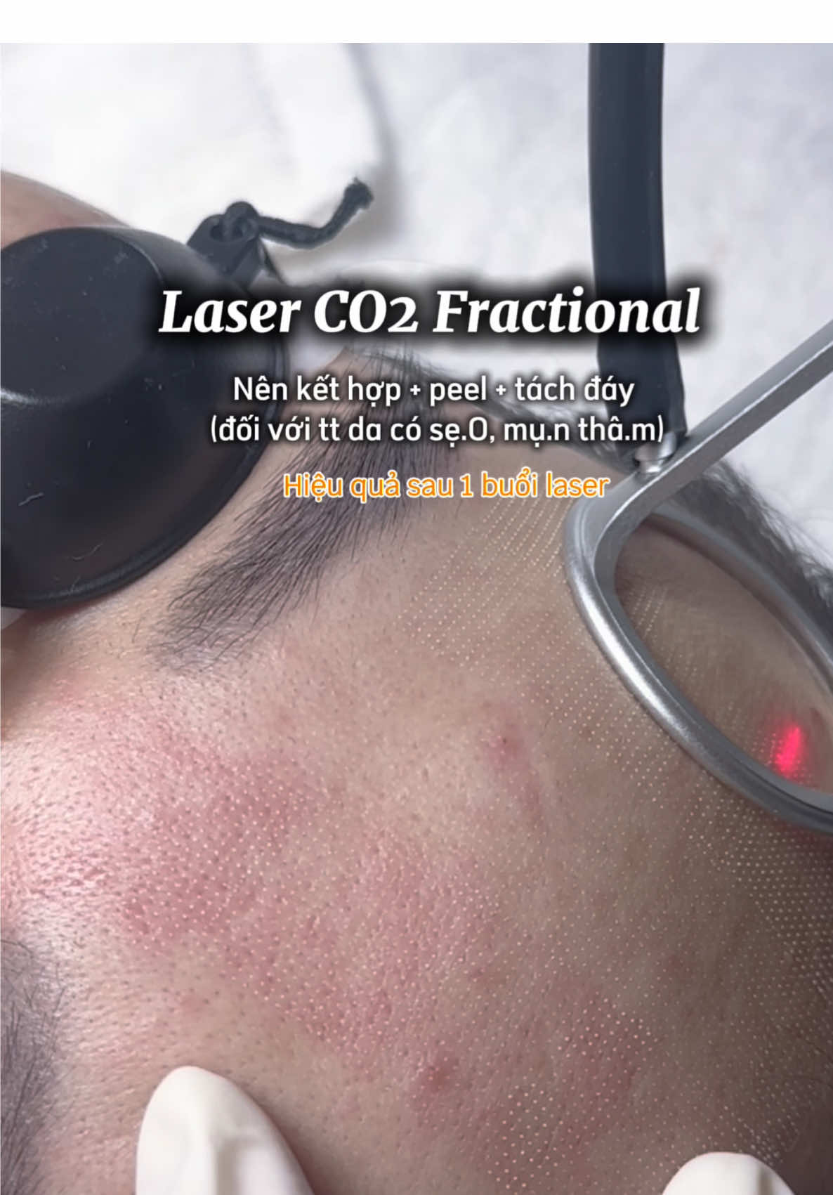 Laser co2 nên kết hợp để da đáp ứng hiệu quả cao hơn trong qtrinh điều trị #nanmunchuanykhoa #spadanang #munlung #trimundanang #detoxCO2 #nanmundanang #skindetox #43danang #laserco2 