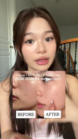 Y’all I was just in Korea too and this was so popular and sold out the Olive Young near me>>  #hyperpigmentarion #darkspot #numbuzin #no5serum #darkspots #glutathione #vitaminc #brightening #sensitiveskin #numbuzinfam @numbuzin 