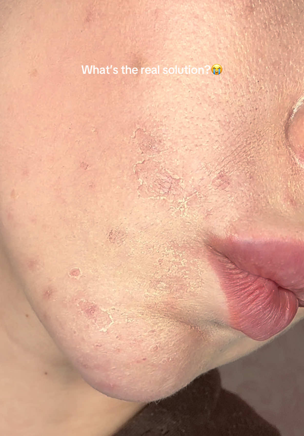 Tried every “miracle” product out there… and my skin still looks like this 😩 Dry. Flaky. Breaking out. Any REAL solutions? 👇 #skinstruggles #dryacneskin  #skincarejourney #helpmyskin #acne #acneproneskin #acneskin #dryskin 