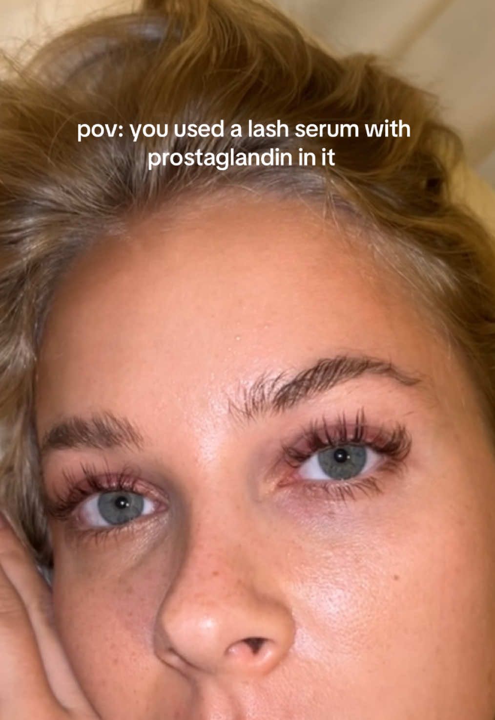 link in bio to my fave prostaglandin free lash serum 🤍 this video is just a reminder to be careful if you have sensitive eyes like me - maybe use a more mild eyelash serum! These were my lashes with NO MASCARA on but my eyelids were not okay #lashes #eyelashserum #prostaglandin 