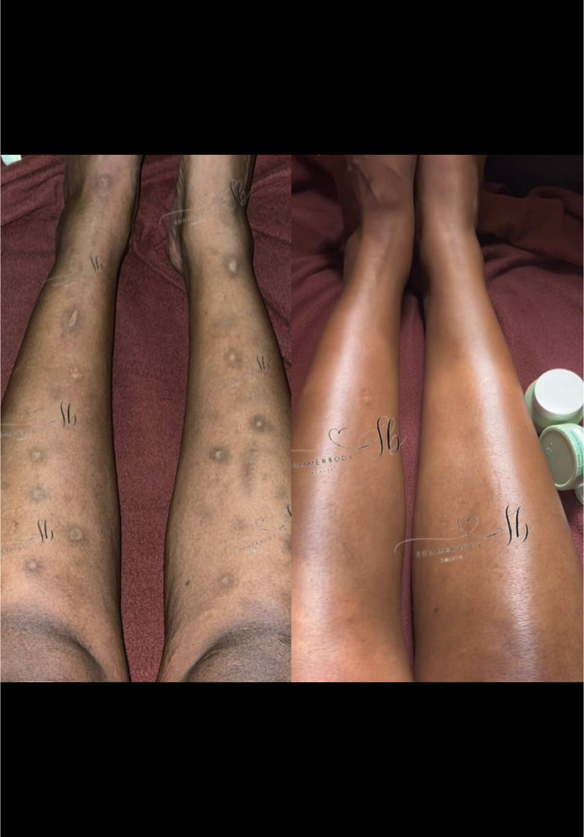 j'appelle ce produit petit mais puissant, comme vous pouvez le voir le merveilleux travail. 💃🏽💃🏽❤️ jambes noires  eliminer les taches noirs  tache noir trend  tache produit  tache acne tache noir sur le corps  enlever les taches hyperpigmentation  eliminer les taches noirs  j'ai une tache Tache jambe #hyperpigmentation #tache #cicatrices  #scar #eliminerlestachesnoires #tachesbrunes #entrejambesnoires 