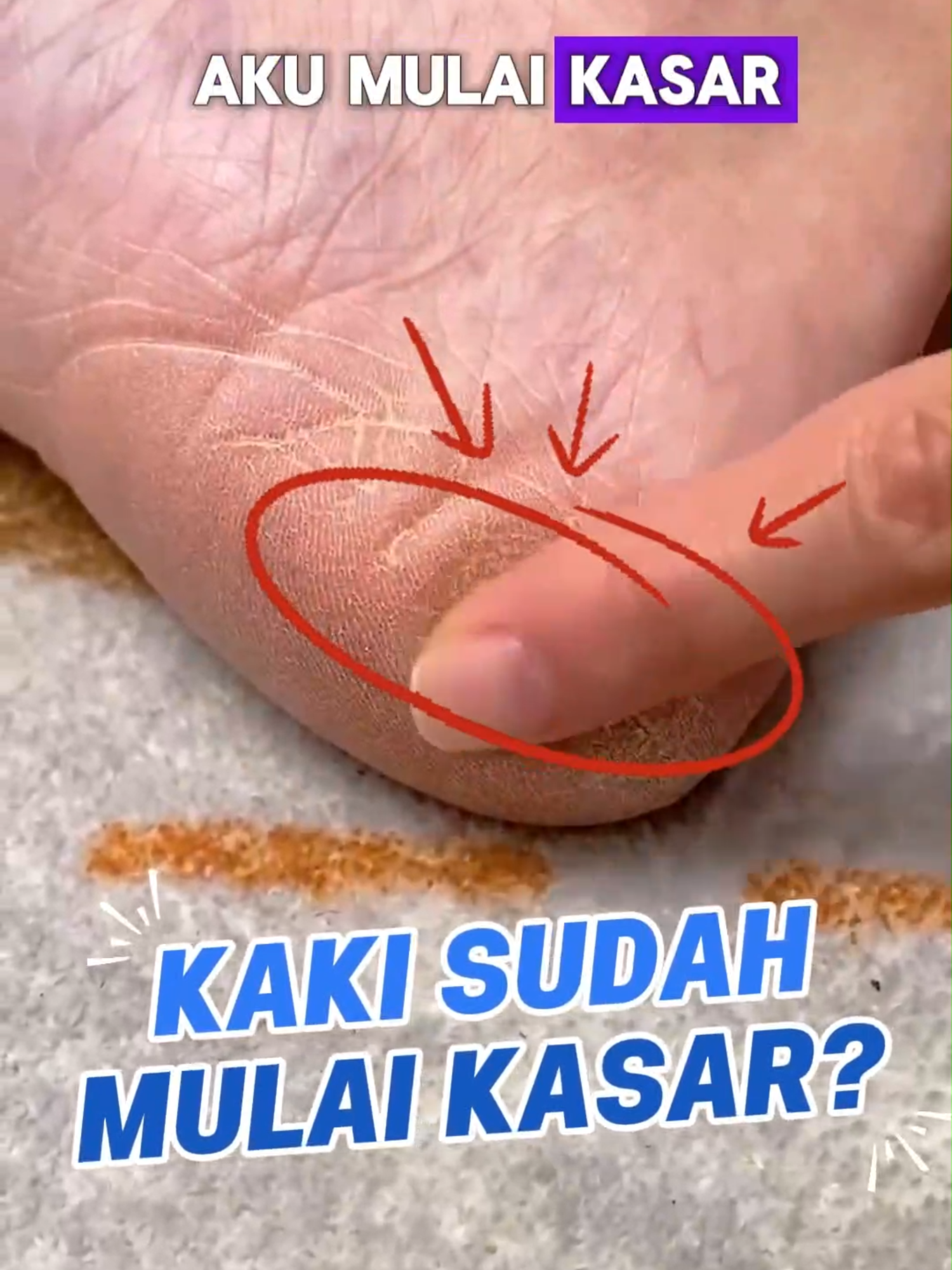Kaki sudah mulai kasar ?! itu tandanya harus eksfoliasi pakai lanbena foot peel mask 🤗💜 #lanbena #lanbenaproducts #newproduct #maskerkaki #footpeelmask #trending #viral #fyp #livetiktok #flashsale #promo