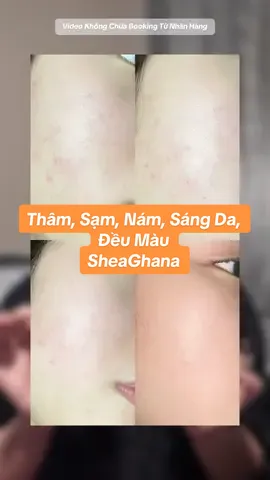 - Sản phẩm đầu tay cô Học luôn tin tưởng trong vấn đề bôi thoa xử lý sắc tố da tại nhà, bao gồm các tình trạng: thâm, nám, sạm, xỉn màu, da không đều màu, cần dưỡng sáng, làm đều màu da…SheaGhana cam tím, chắc chắn luôn. - Để làm được cái video này mất tới nửa năm trời #cunghocchamda #cohoctruyeu #goclamdep #chamsocda #sheaghana 