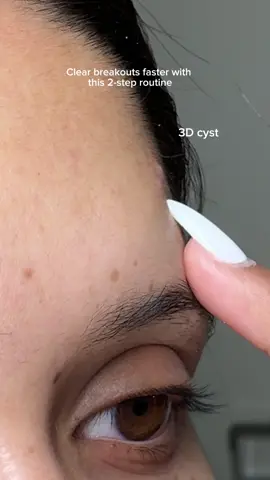 One pimple. Two products. 12 hours. ⏱️ I used the Tea-Trica Spot Cream to calm the breakout, then sealed it in with the @SKIN1004 US Spot Patch to speed up healing. Formulated with 80% of a highly concentrated Tea-Trica formula, it helps soothe sensitive, irritated skin fast without clogging your pores. No more redness, swelling, or temptation to pick. This combo is now my go-to for emergency breakouts. 💚 AD #teatrica #skin1004 #spotcream #pimplepatch #acnetreatment #kbeauty #acneproneskin #acneskin #acnepatch 
