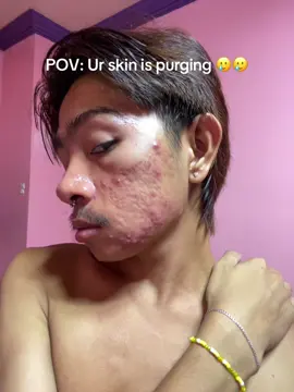 #purging #acne #purgingvsbreakout #azelaicacid #azelane #acnetreatment 