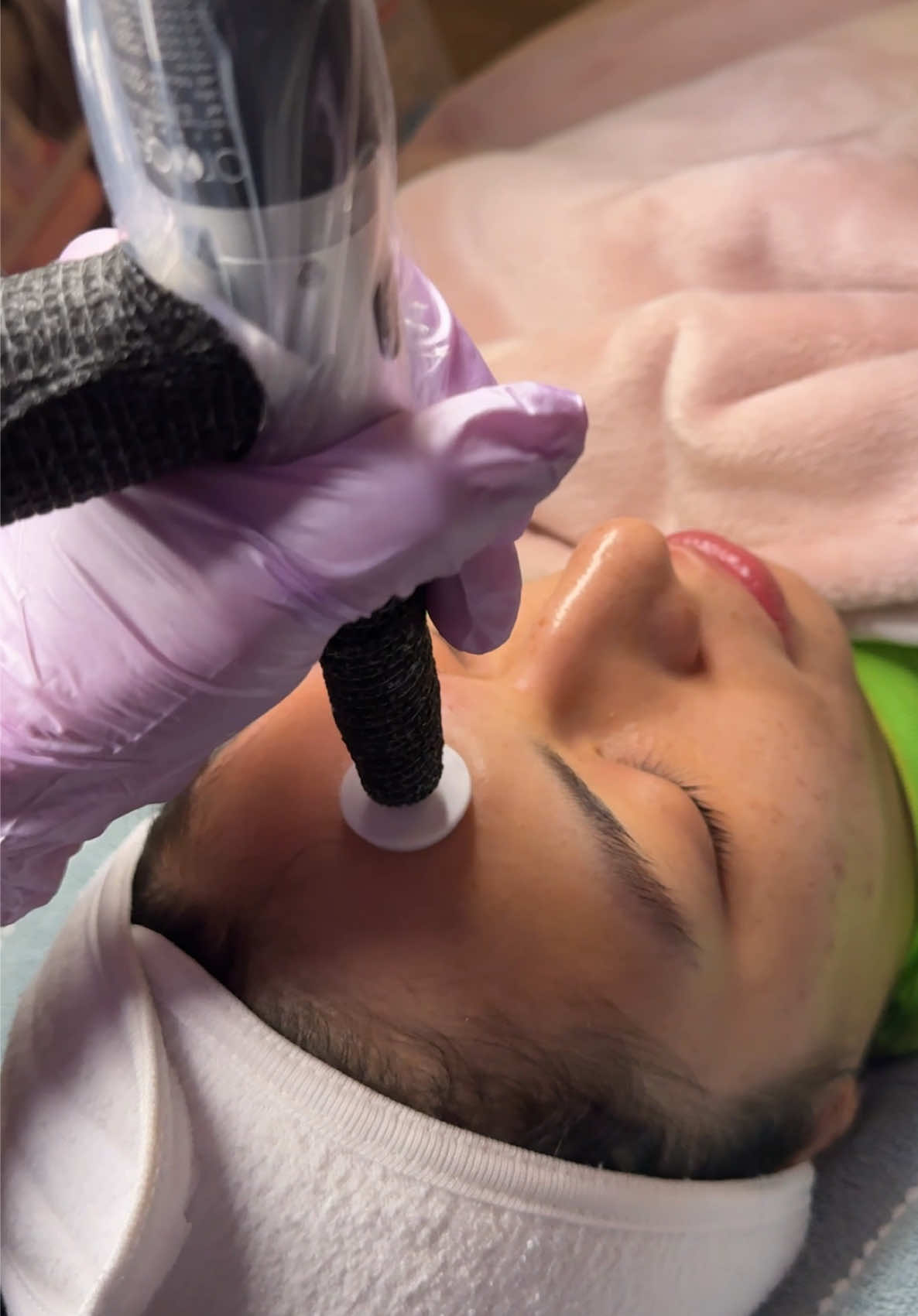 Procell Microchanneling. 💉🖤 The “I want to target EVERY SKIN CONCERN I have” anti-aging facial service! Literally EVERYTHING. I brought Procell Microchanneling on bc I felt it was definitely the missing piece on my service menu. 🧩 I’m an Acne Specialist & LOVEEE clearing acne but after clearing my clients, their skin concern was no longer acne but was, “How can I get rid of acne scarring?” “How can I get rid of this left over acne pigment?” I knew I needed to bring on a new service to really target scarring & post getting clear. ✨ Procell Microchanneling is EVOLVED Microneedling with only 90 minutes of downtime! Not your usual 7 days downtime with Microneedling! Procell creates tiny micro injuries in the skin, stimulating the body’s natural healing response & triggers the production of collagen & elastin. Procell helps improve: •Acne Scarring  •Fine Lines & Wrinkles •Hyperpigmentation  •Stretch Marks •Uneven Skin Tone •Texture  Every client post Procell will take home 1 week’s worth of aftercare serums that contain GROWTH FACTORS, Cytokines, & Peptides included with your service at no additional cost!  Procell is THAT SERVICE you need to target 🎯 everything! We love her! ❤️‍🔥 #skintransformation #advancedskincare #dfwesthetician #collageninductiontherapy #antiagingskincare #procelltherapies #microneedlingtherapy #estheticianlife 