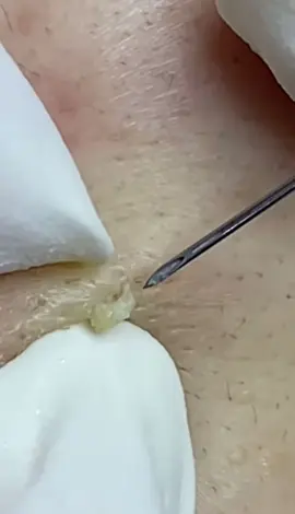 relaxing music + satisfying video = perfection 😍😍😍 #CleanTok #viralvideos #blackheads #limpeza #foryoupage #satisfaction 