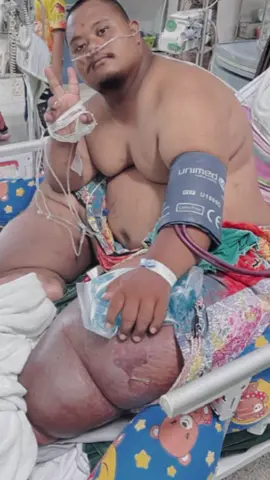 ✌️♥️ กำลังจายหน่อยงับ!!! #ดิงท่าน้ำ #ดาวน์ซินโดรม #downsyndrome #ดิงขาใหญ่ #พิการกายแต่ไม่พิการใจ #ต่อมน้ำเหลืองอุดตัน 