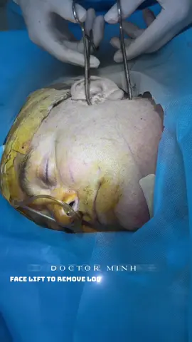 Facelift #liposuction #Facelift #cosmeticsurgery #indonesia🇮🇩 #news 