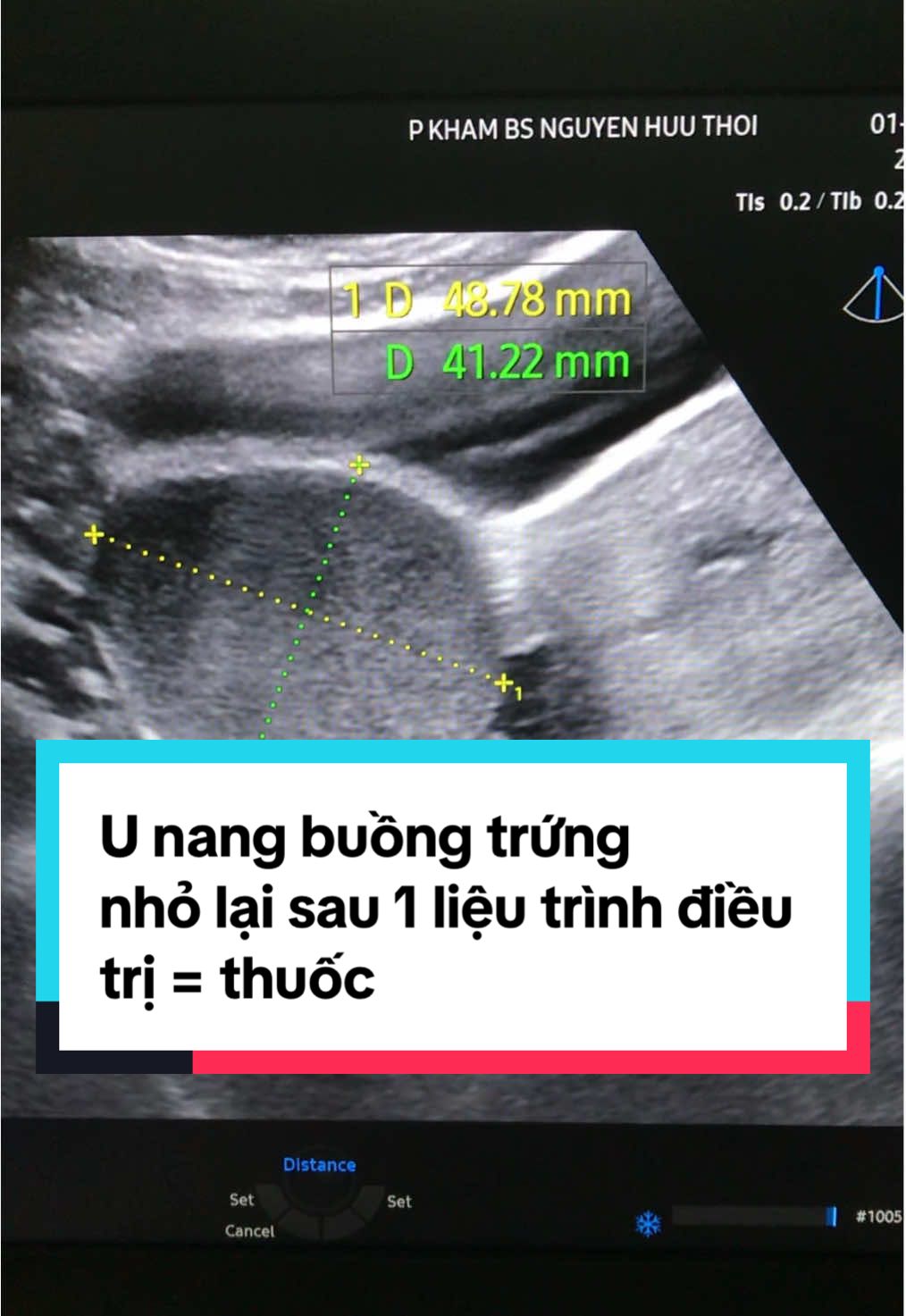 Điều trị u nang buồng trứng#bsthoi #đakhoatrungương #chuyenkhoaphusan #unangbuongtrung 