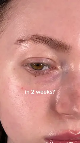 2 weeks with Mary&May TXA+ Glutathione eye cream 🤍 You can find it on Amazon! #eyecream #darkcircles #kbeauty #koreanskincare #hyperpigmentation #marynmay  @Mary&May Official 