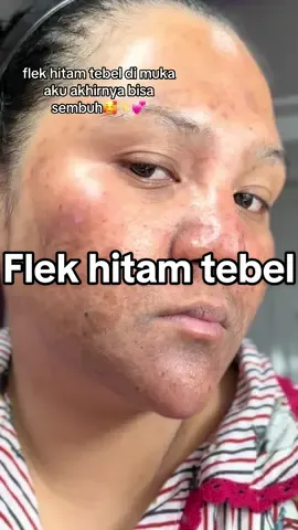 Flek hitam kalian semua udah sembuh blom? kalian udah pake apa ajah ni buat sembuhin flek hitam kalian? komen yh say biar bisa aku rekomendasikan produk yg cocok dan bagus buat flek☹️💕🙏🏻 #flekhitam #fyp 