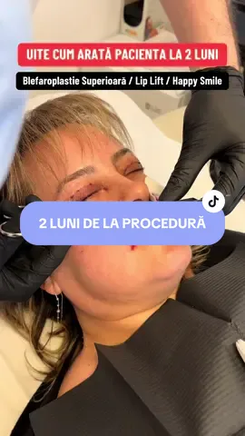 Rezultat la 2 luni de la Blefaroplastie, Lip Lift si Happy Smile #legacymed #beauty #surgery #browlift #medic #facelifting #endobrowlift #temporalift #browlifting #doctor #facelift 