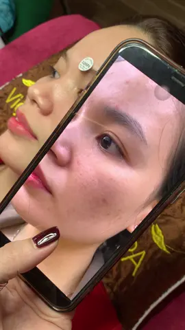 Cam thường ghiền#lấynhanmunbangtay#chamsocdamun#chamsocdaseo#chamsocdanam#tanbinh#govap #Lequynh#Lqspa#hocnghespa  #chamsocda #lequynhspa#lequynhspahcm#vienthammylqspa#lqspabeautyacdemy#LQSPABeaty&Acedemy#laymunbangtămbông 