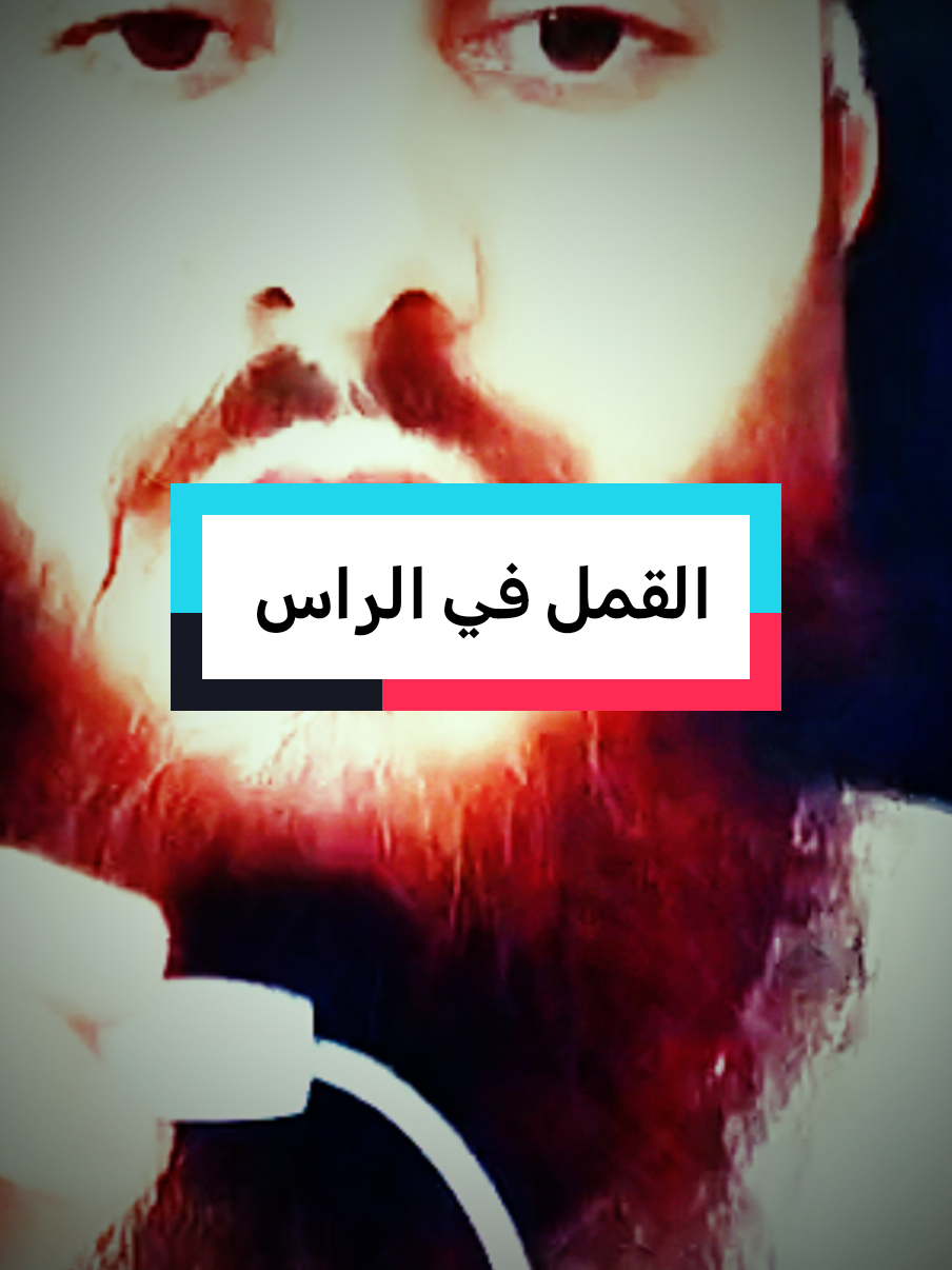 القمل في الراس #fypシ゚ #fypviralシ #فهدالقرني 
