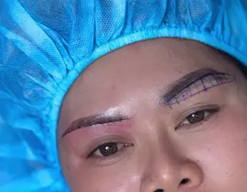 Treo cung mày 