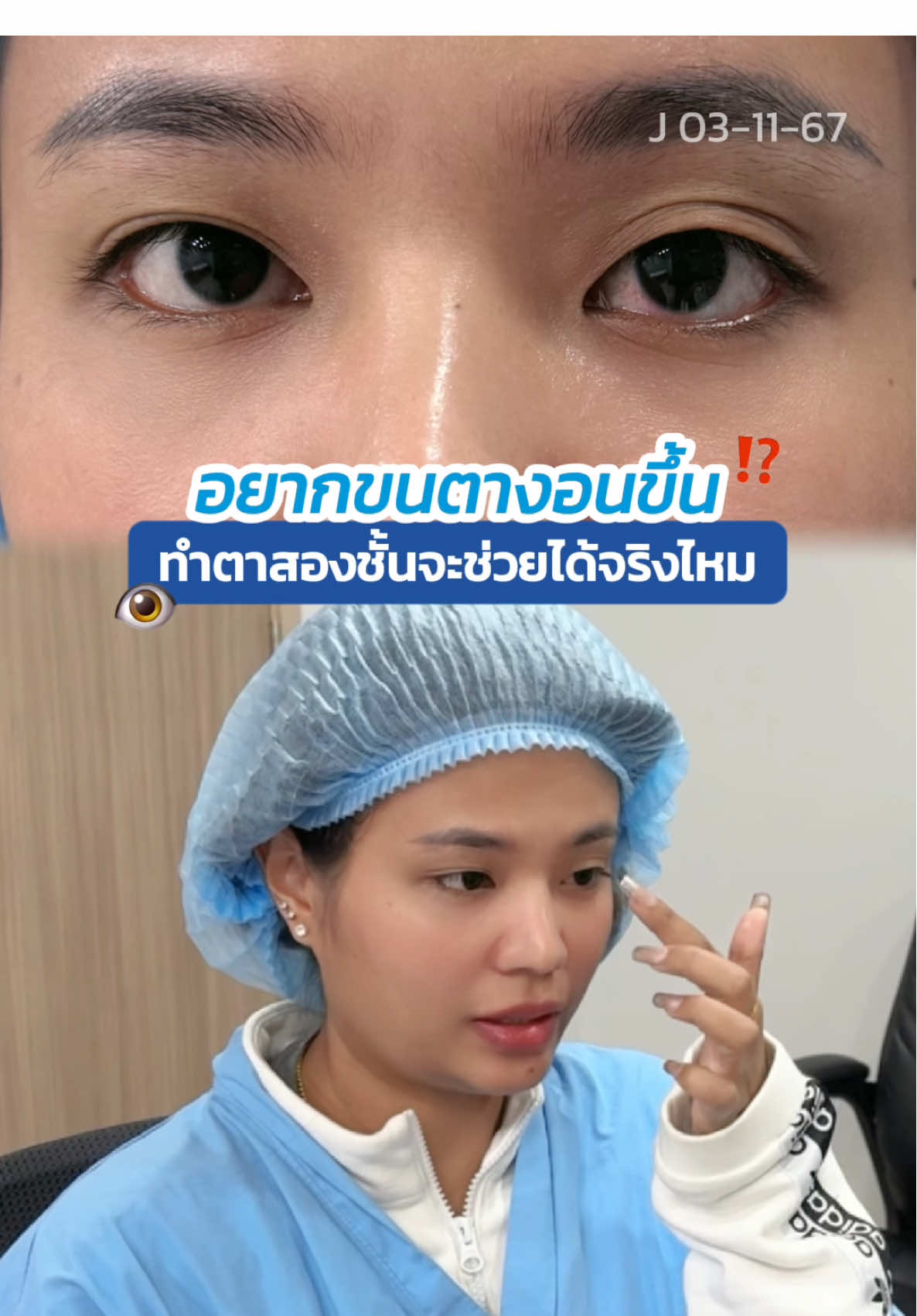 อยากขนตางอนขึ้น 👁️ ทำตาสองชั้นช่วยได้จริงไหม ⁉️ #รีวิวตาสองชั้น #skyclinic #จักษุแพทย์ #ทีมแพทย์หมอสกาย #ศัลยกรรมตา #ทำตาที่ไหนดี #สกายคลินิก 