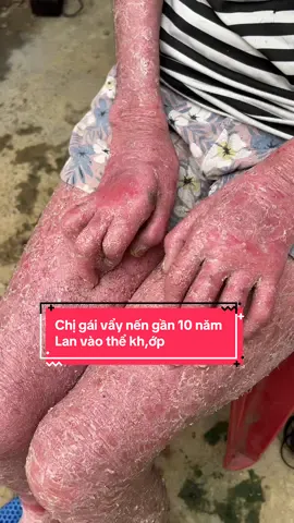 Chị gái vẩy nến gần 10 năm người toàn vẩy,lần vào kh,ớp c.o r.út các ngón tay @Thị Tuyến DC 35(2) #vẩynến #viêmdacơđịa #viêmdatiếtbã 