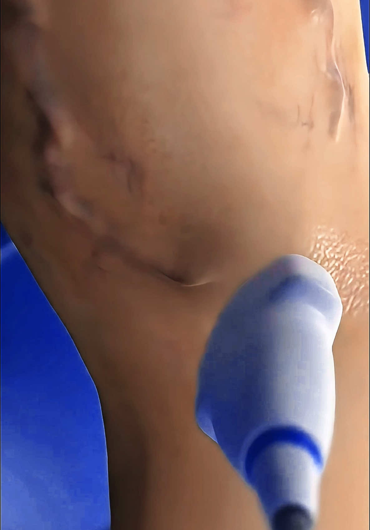 Treating Varicose Veins With Laser! #VaricoseVeins #LaserTreatment #VeinHealth #EVLT #MedicalTikTok #TikTokDoctor #PainFreeLegs #ModernMedicine #VeinSurgery #SurgeryExplained #WellnessJourney #HealthTalk #LegPainRelief #NoMoreVeins #HealingProcess